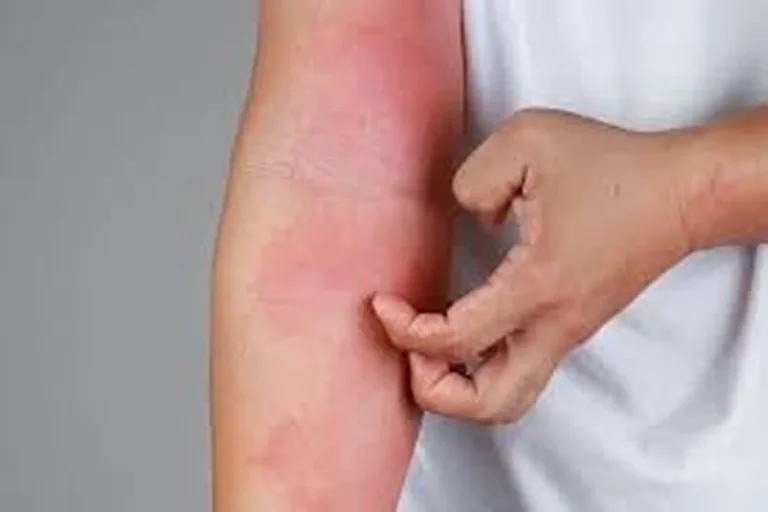 Eczema in Children