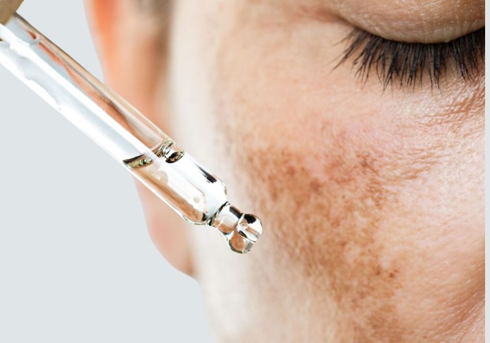 Melasma
