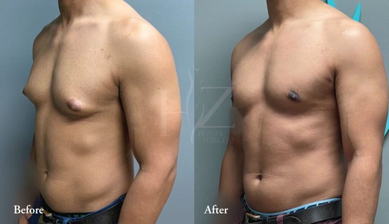 Gynaecomastia