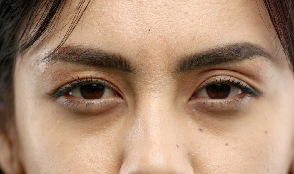 Eyelid
